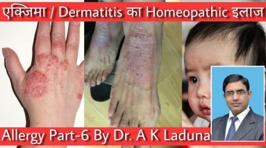 Allergy Part-6 By Dr. AK Laduna, Eczema/ Dermatitis signs, Types, Care and Homeopathic Treatment 18 1688621175 maxresdefault
