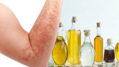 Home Remedies for Eczema, a Dry Skin Condition | By Top 5. 16 1688624872 hqdefault