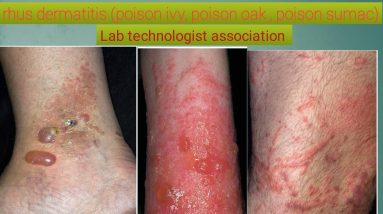 What is rhus dermatitis and their treatment 14 1688628537 maxresdefault