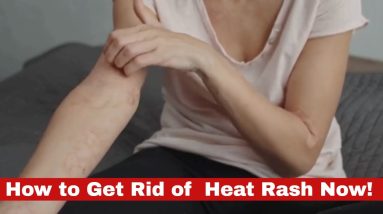 Easy and Effective: How to Get Rid of Heat Rash Now! 12 1688676682 maxresdefault