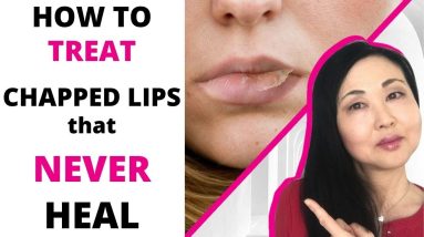 How to TREAT Chapped Lips that never heal (Actinic Cheilitis-4 GRADES) 14 1688763897 maxresdefault