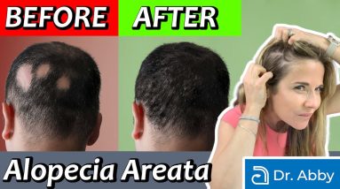 Alopecia Areata: Causes and Treatment from a Dermatologist 8 1688829812 maxresdefault