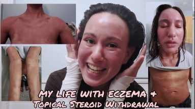 Intro to my life with eczema (atopic dermatitis) & topical steroid withdrawal 2 1688895866 maxresdefault