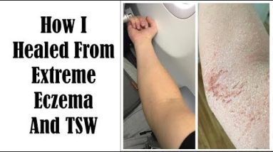 Top 10 Things To Heal From Eczema and TSW - My Journey of Healing 16 1688906846 hqdefault