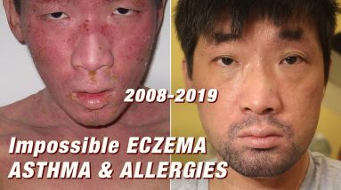 2008-2019: Curing Impossible Eczema, Food Allergy, Asthma (Dupixent, Cyclosporine, Cromolyn) | Ep243 10 1688917932 maxresdefault