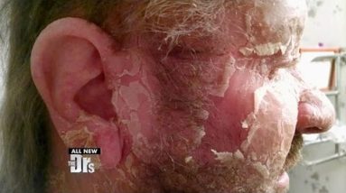 Help for Man with Extreme Eczema 4 1688928993 hqdefault
