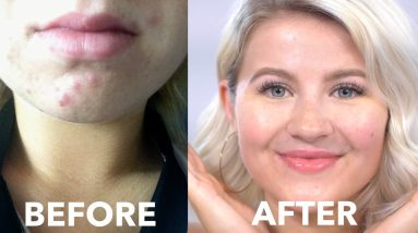 HOW TO: Cure Acne Naturally | Fast & Cheap | Milabu 20 1688946299 maxresdefault