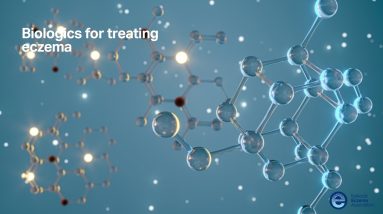 Biologics for treating eczema 12 1688951078 maxresdefault