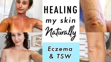 How I CURED Eczema & Topical Steroid Withdrawal NATURALLY | My Skin Healing Journey 18 1688976659 maxresdefault