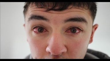 Treatment For Bacterial Conjunctivitis 6 1688977227 hqdefault