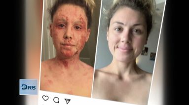 Hear Woman’s Struggle to Get Off Topical Steroids 16 1688980355 maxresdefault