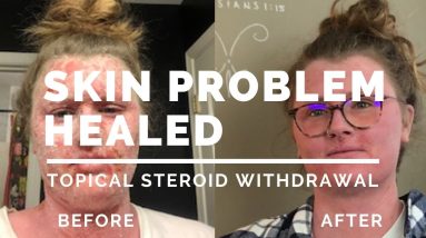 Topical Steroid Withdrawal Healing | Total Wellness Program 4 1688980862 maxresdefault