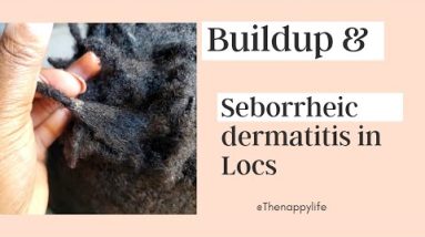 Buildup & Seborrheic Dermatitis in Locs / How To Get Rid Of Buildup in Locs 2 1689008793 hqdefault