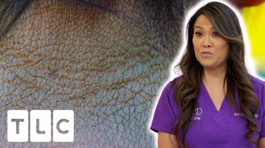 Dr Lee Helps Patient With Atopic Dermatitis | Dr Pimple Popper: This Is Zit 18 1689013412 maxresdefault