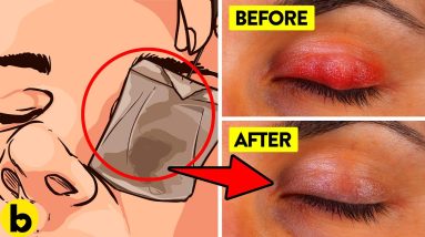 14 Easy Home Remedies For Styes You Need To Know 8 1689023477 maxresdefault
