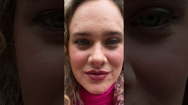 MY ACCUTANE JOURNEY 18 1689082997 maxresdefault