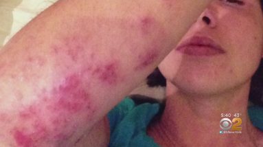 New Drug Approved For Kids With Eczema 18 1689123310 maxresdefault