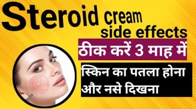 steroid cream ke side effects|how to cure steroid cream side effects|nase dikhna aur skin patli hona 16 1689145835 hqdefault