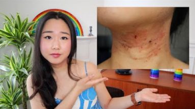 My life with Eczema & starting Dupixent (Dupilumab) 2 1689152710 hqdefault