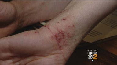 Injections Offer Relief To Those Suffering From Eczema 12 1689171028 maxresdefault