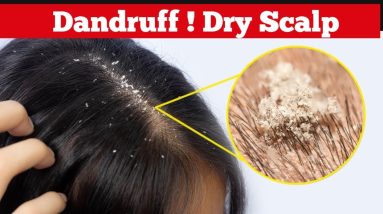Dandruff । सूखी त्वचा को कैसे सही करें। Dry Scalp। how to remove dandruff। dandruff kaise hataye 16 1689202767 maxresdefault