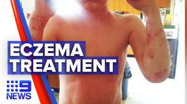 'Life changing' eczema treatment now approved for teenagers | Nine News Australia 18 1689233295 maxresdefault