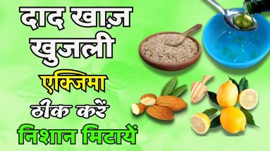 दाद खाज खुजली Eczema Ringworm को ख़त्म करें और निशान मिटायें | Eczema, Itching Problem 6 1689244936 maxresdefault