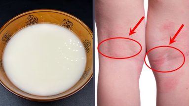 濕疹有救了!80歲奶奶教我一個土偏方,讓濕疹快速消退,多年不再復發,完全沒有副作用 16 1689264988 maxresdefault