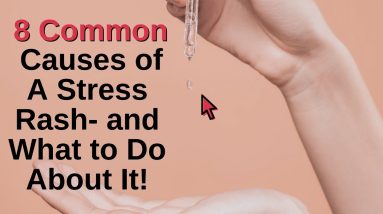 8 Common Causes of a Stress Rash 12 1689269526 maxresdefault