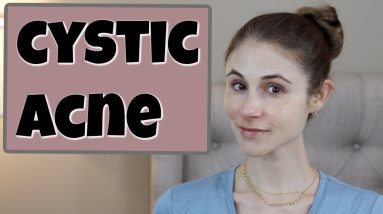CYSTIC ACNE Q&A| DR DRAY 4 1689332182 maxresdefault