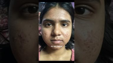 How I cleared my acne prone skin skin in 30 days #skincare #shorts #tretinoin #skincareproducts 14 1689346423 maxresdefault