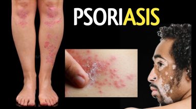 Psoriasis types symptoms causes || सोरायसिस क्या है क्यों होता है कारण लक्षण प्रकार || सोरायसिस 16 1689362180 maxresdefault