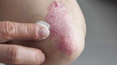 Eczema - Boys Town National Research Hospital 16 1689402102 hqdefault