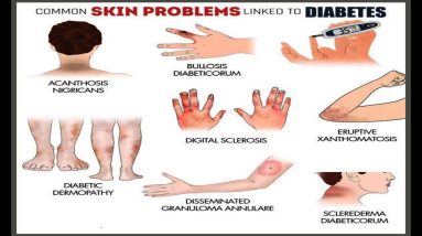Common Skin Problems Linked to Diabetes 10 1689413096 maxresdefault