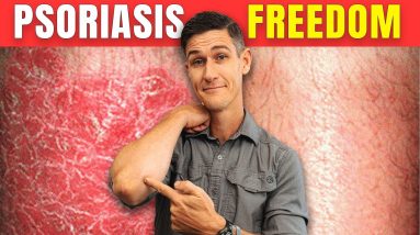 3 Psoriasis Treatment Secrets (NOT diet or supplements) 8 1689494244 maxresdefault