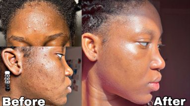 From Hormonal Acne to Clear Skin - How healing my Gut Health cured my acne NATURALLY *with pictures* 18 1689580282 maxresdefault