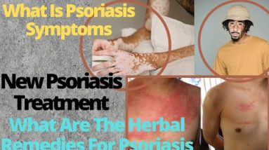 What Is Psoriasis Symptoms||New Psoriasis Treatment||What Are The Herbal Remedies For Psoriasis 12 1689584532 hqdefault