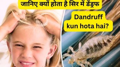 जानिए क्यों होता है सिर में डेंड्रफ | What Causes Dandruff ? 8 1689591257 maxresdefault