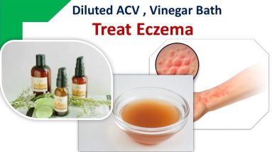How to Use Apple Cider Vinegar to Treat Eczema - Use Diluted ACV, Have a Vinegar Bath 6 1689591899 maxresdefault