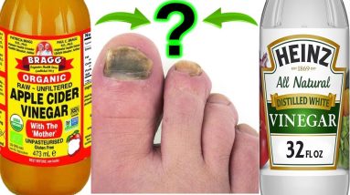 What is Better For Toenail Fungus - White Vinegar or Apple Cider Vinegar ? 8 1689610274 maxresdefault