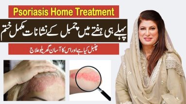 Psoriasis Treatment by Dr. Bilquis | Chambal ka Ilaaj | چنبل کی بیماری کا علاج 10 1689692476 maxresdefault
