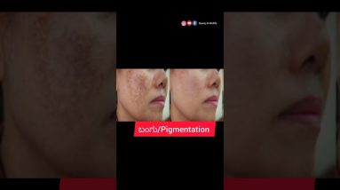ಬಂಗು/Pigmentation ಗೆ ಬೆಸ್ಟ್ remedy/How to remove Pigmentation at home 8 1689696140 maxresdefault