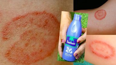 सिर्फ 2 दिन में दाद खाज खुजली (Eczema) को जड़ से खत्म कर देगा यह घरेलू नुस्खा Ringworm Treatment 12 1689789858 maxresdefault