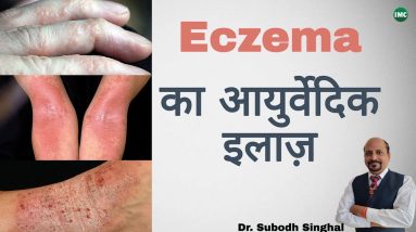 Eczema / एग्जिमा - कारण, लक्षण और इलाज़ | IMC Products | 10 1689793531 maxresdefault