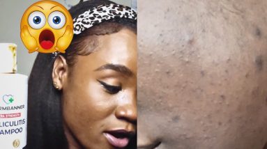 A Life-Changing Solution: How This Product Rescued My Face from Adult Acne 4 1689837495 maxresdefault
