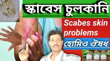 স্কাবেস চুলকানি ।। স্ক্যাবেস চুকানির হোমিও ঔষধ ।। Dr Nityananda pal 16 1689953377 hqdefault