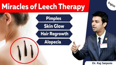 Miracles of Leech | Leech Therapy for Pimples, Skin Glow, Hair Regrowth, Alopecia | Jyovis Dr. Raj S 8 1690040695 maxresdefault