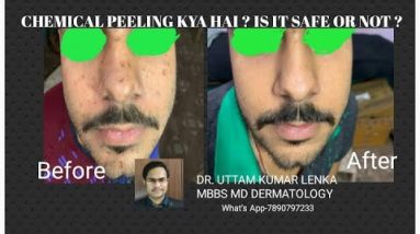 What is chemical peeling?is it safe?(केमिकल पीलिं क्या है?) /কেমিক্যাল পীলিঙ্গ কী ? 20 1690101956 hqdefault
