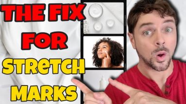 Best Ways To Remove Stretch Marks | Skincare & Treatments That Work | Chris Gibson 2 1690125201 maxresdefault