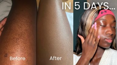 MY 5 DAY ECZEMA TRANSFORMATION | HOW TO HEAL & CLEAR YOUR SKIN RAPIDLY 8 1690141205 maxresdefault